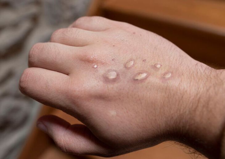Mpox course to support GPs to ‘stay informed and proactive’