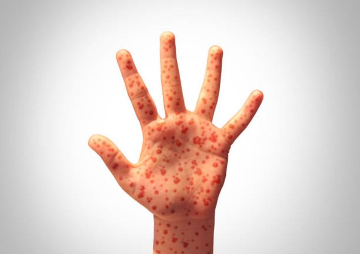 Measles alert issued for Sydney’s north west