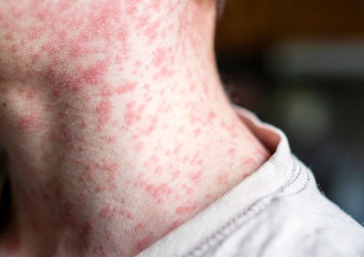 Measles Alert in Sydney 30 Jan, 2026