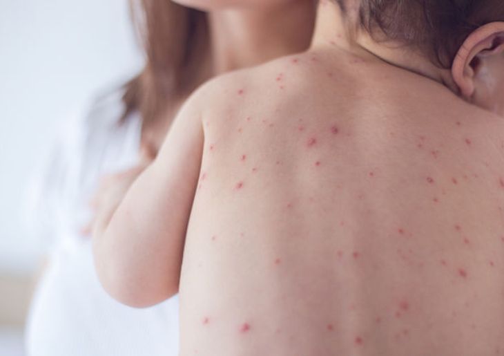 Measles Cases Rise in Sydney – NSW Health Issues Alert
