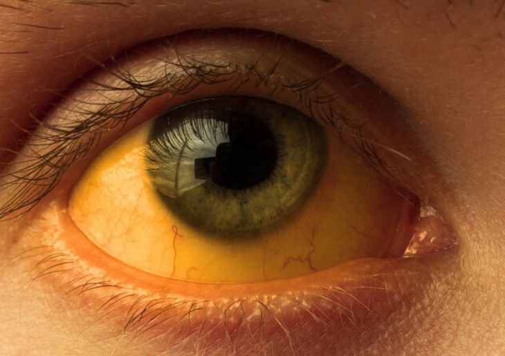 Australia clears trachoma as public health concern