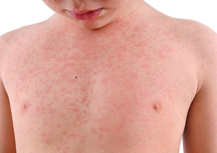 Measles Warning for Sydney Airport and CBD After Infectious Case